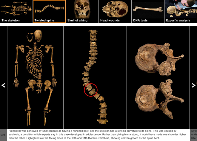 The spine of Richard III shows scoliosis